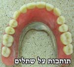 תותבות על שתלים