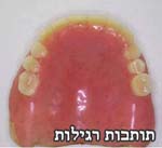 תותבות רגילות