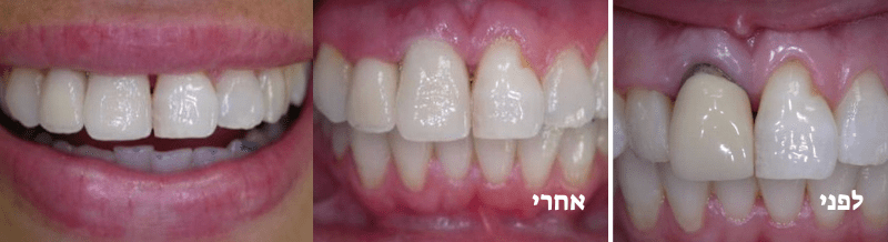 שיקום באמצעות כתרים (כתרים קדמיים) - לפני ואחרי