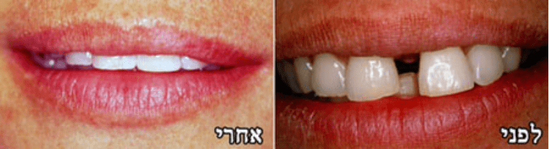 יישור שיניים למבוגרים