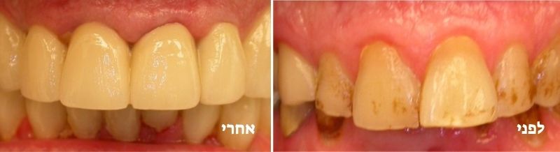 טיפול במשנן שחוק לפני ואחרי