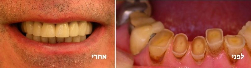 טיפול במשנן שחוק לפני ואחרי
