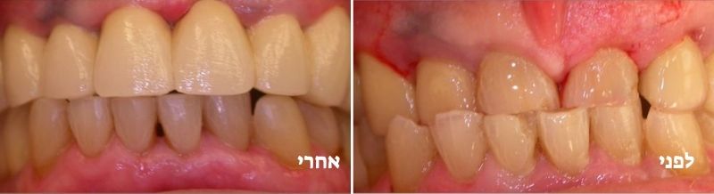 טיפול במשנן שחוק לפני ואחרי
