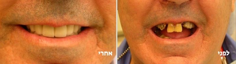 טיפול במשנן שחוק לפני ואחרי