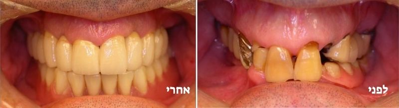 טיפול במשנן שחוק לפני ואחרי
