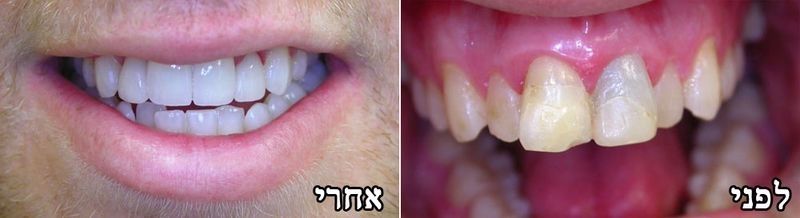 שיקום מורכב לפני ואחרי