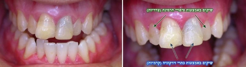 שיקום מורכב