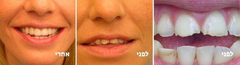 שיקום באמצעות כתרים קדמיים - לפני ואחרי