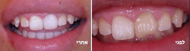 הלבנת שן שהשחירה לאחר טיפול שורש