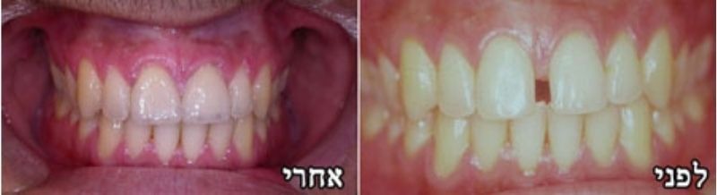 לפני ואחרי ציפויי חרסינה