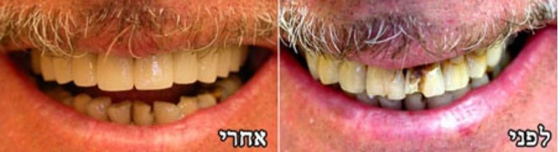 כתרי חרסינה קדמיים על מתכת אצילה