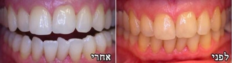 לפני ואחרי הלבנת שיניים
