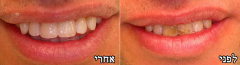 כתרי חרסינה קדמיים ללא מתכת (זירקוניה)